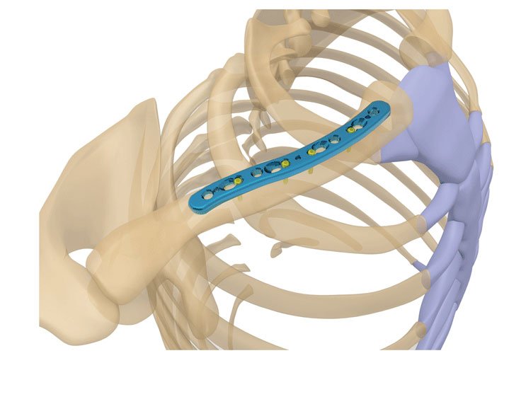Klavikula Plakları