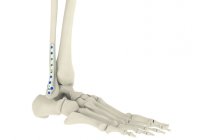 Distal Fibula Plakları