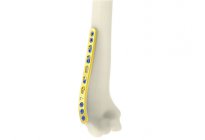 Distal Humerus Lateral Plakları