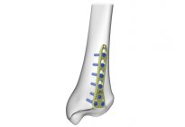 Distal Tibia Posterior Plakları