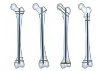 Femur İntramedüller Çivi