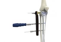 MISS Proksimal Tibia Lateral Plakları