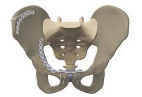 Pelvis – Asetabulum Plak