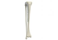 Proksimal Tibia Lateral Plakları