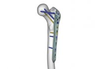 Proksimal Femur Plakları